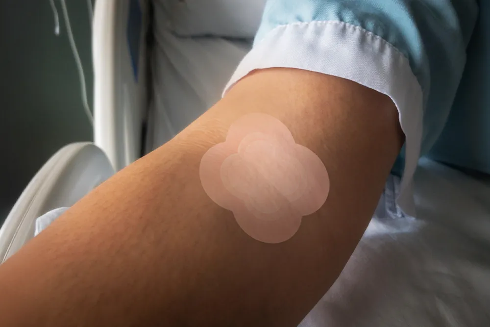 Curativo de espuma com prata aplicado no braço de paciente deitado, mostrando cobertura discreta e proteção da área após procedimento.