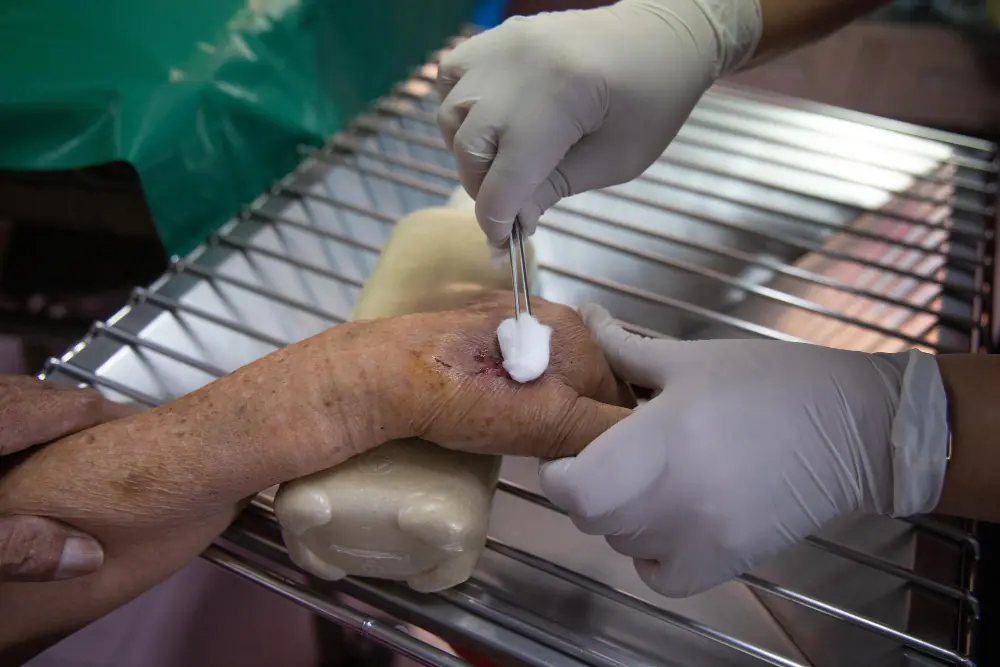 Profissional de saúde removendo biofilme da ferida com pinça e gaze
